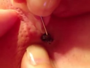 enormous blackhead being extracted